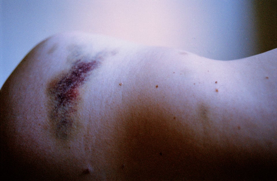 Teresa Eng — Speaking of Scars